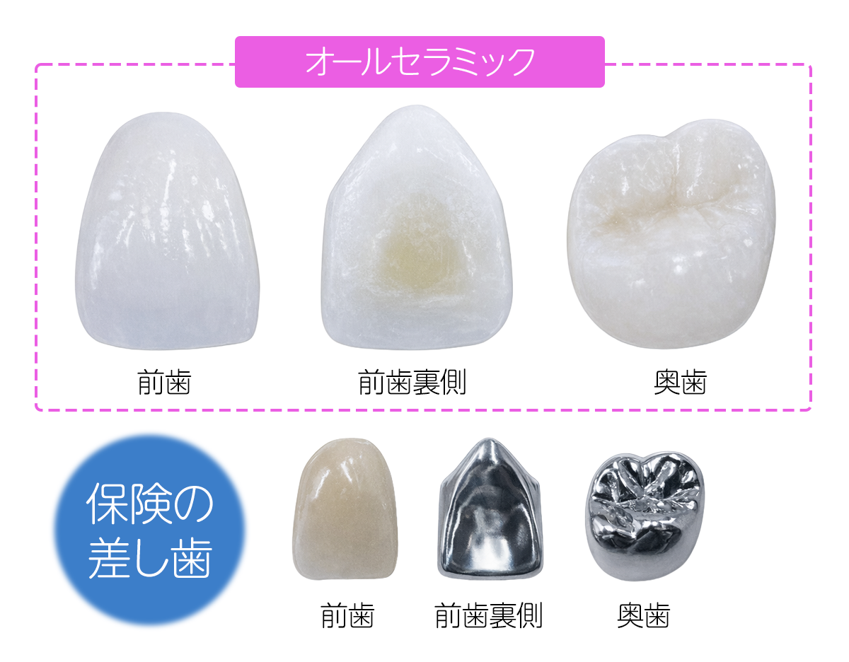 オールセラミック