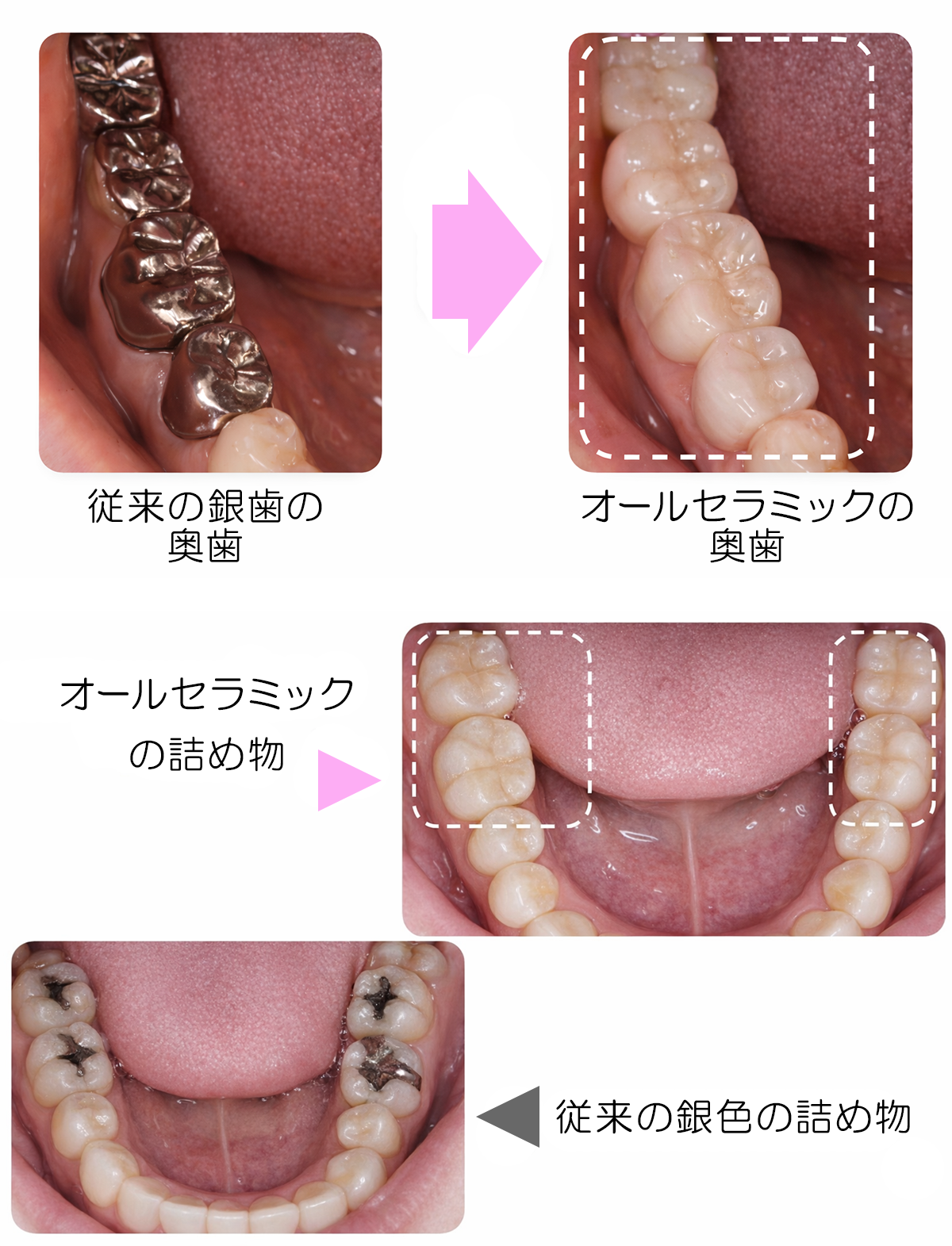 奥歯や詰め物にも使えるオールセラミック
