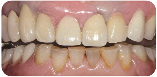 はりがねの見えない入れ歯